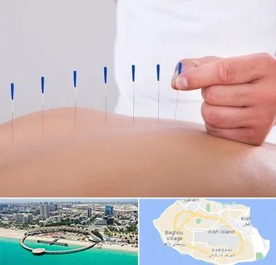 دکتر طب سوزنی در کیش