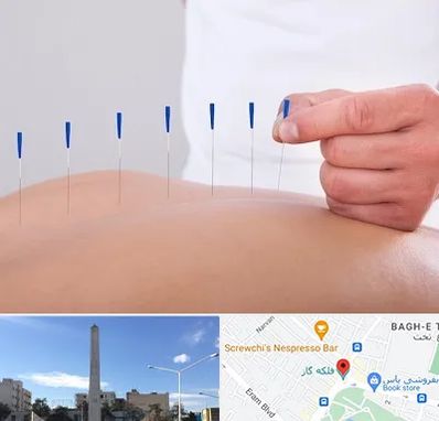 دکتر طب سوزنی در فلکه گاز شیراز