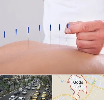 دکتر طب سوزنی در شهر قدس