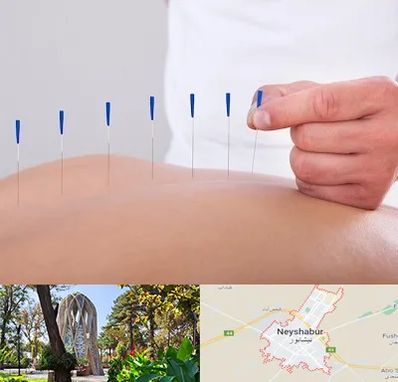 دکتر طب سوزنی در نیشابور