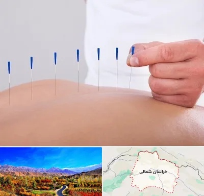 دکتر طب سوزنی در خراسان شمالی
