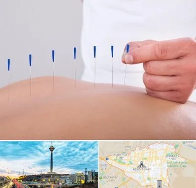 دکتر طب سوزنی در تهران