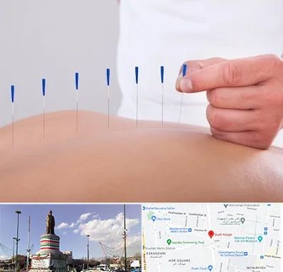 دکتر طب سوزنی در کارگر جنوبی