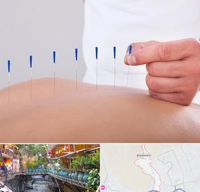 دکتر طب سوزنی در درکه