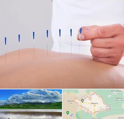 دکتر طب سوزنی در مرند