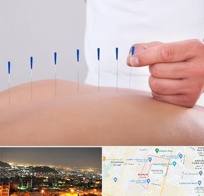 دکتر طب سوزنی در مارلیک کرج