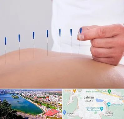 دکتر طب سوزنی در لاهیجان