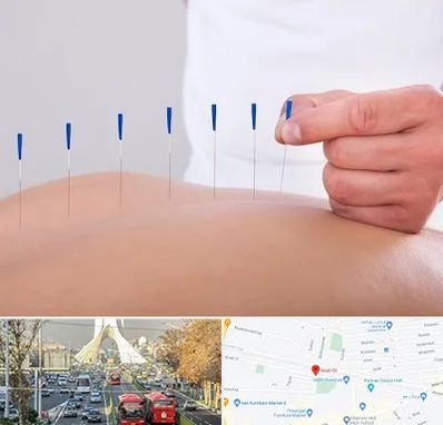 دکتر طب سوزنی در خیابان آزادی