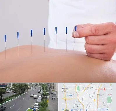 دکتر طب سوزنی در ستارخان 