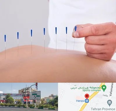 دکتر طب سوزنی در هروی 