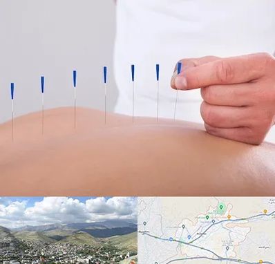 دکتر طب سوزنی در رودهن