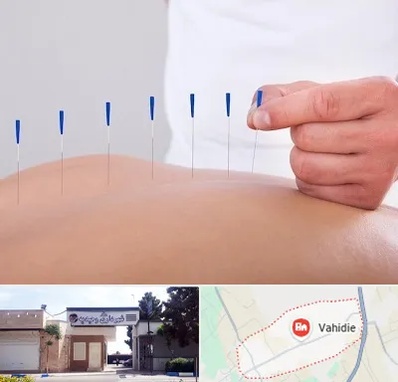 دکتر طب سوزنی در وحیدیه شهریار