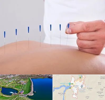 دکتر طب سوزنی در مهاباد