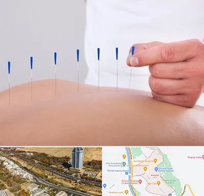 دکتر طب سوزنی در خیابان نیایش شیراز