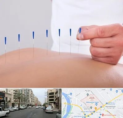 دکتر طب سوزنی در زیتون کارمندی اهواز