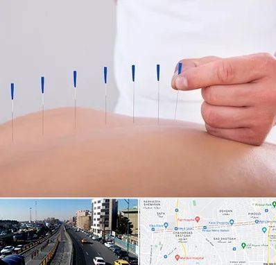 دکتر طب سوزنی در پیروزی