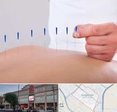 دکتر طب سوزنی در قائمیه اسلامشهر