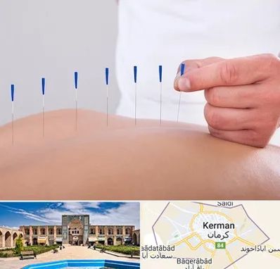 دکتر طب سوزنی در کرمان
