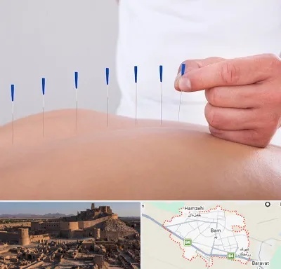 دکتر طب سوزنی در بم
