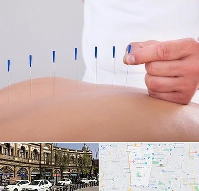 دکتر طب سوزنی در منطقه 11 تهران