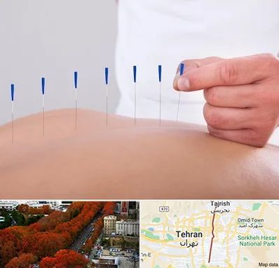 دکتر طب سوزنی در ولیعصر