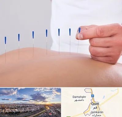 دکتر طب سوزنی در قم