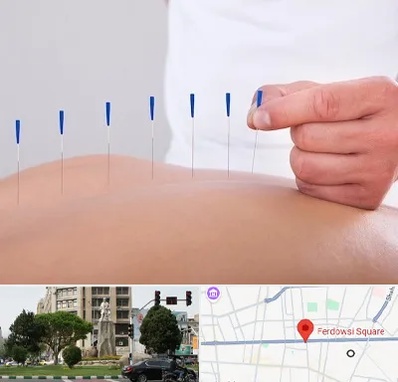 دکتر طب سوزنی در میدان فردوسی تهران