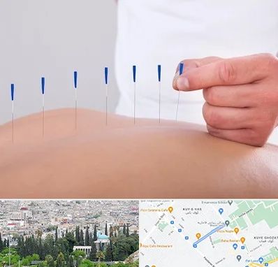 دکتر طب سوزنی در محلاتی شیراز