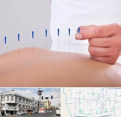 دکتر طب سوزنی در 17شهریور