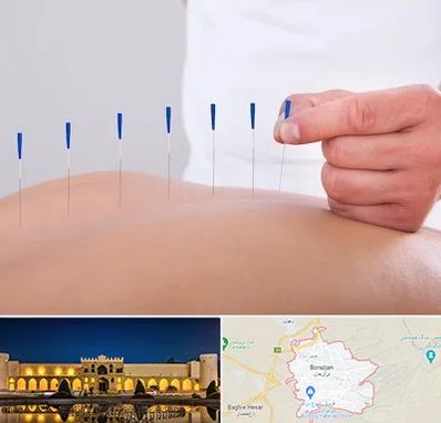 دکتر طب سوزنی در برازجان