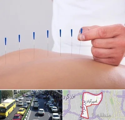 دکتر طب سوزنی در امیرآباد