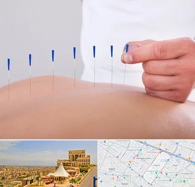 دکتر طب سوزنی در هاشمیه مشهد