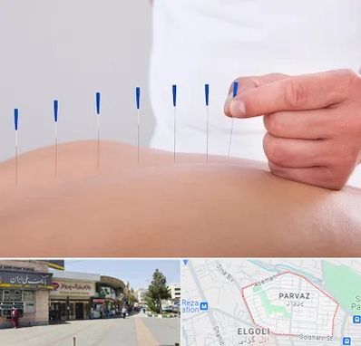 دکتر طب سوزنی در پرواز تبریز