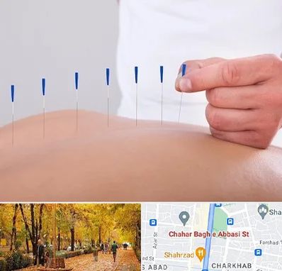 دکتر طب سوزنی در چهارباغ اصفهان