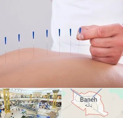 دکتر طب سوزنی در بانه