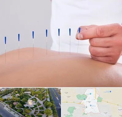 دکتر طب سوزنی در کاشمر