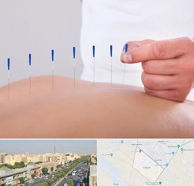 دکتر طب سوزنی در کیانمهر کرج