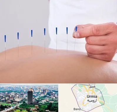 دکتر طب سوزنی در ارومیه