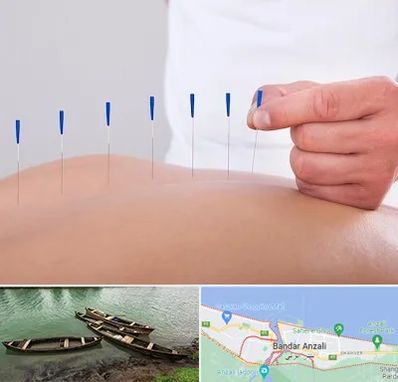 دکتر طب سوزنی در بندر انزلی