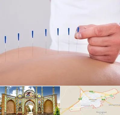 دکتر طب سوزنی در سمنان