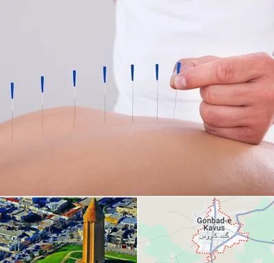 دکتر طب سوزنی در گنبد کاووس