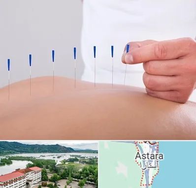 دکتر طب سوزنی در آستارا