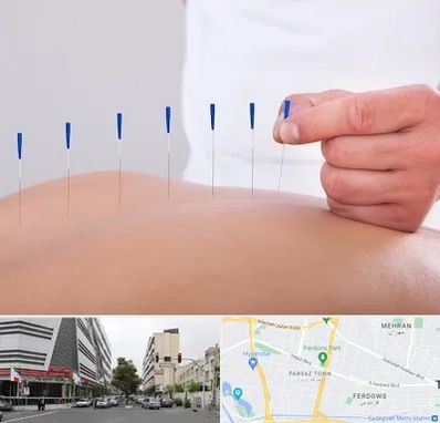 دکتر طب سوزنی در بلوار فردوس 