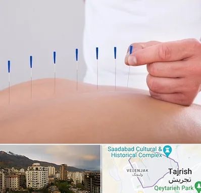 دکتر طب سوزنی در زعفرانیه