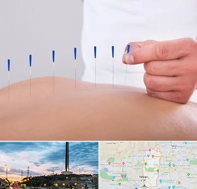 دکتر طب سوزنی در منطقه 2 تهران