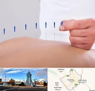 دکتر طب سوزنی در تایباد