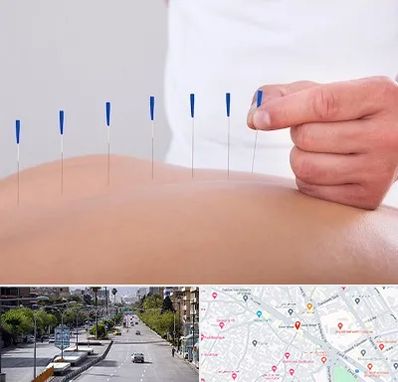 دکتر طب سوزنی در خیابان زند شیراز