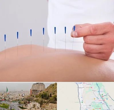 دکتر طب سوزنی در فرهنگ شهر شیراز