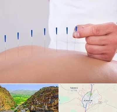 دکتر طب سوزنی در کامیاران