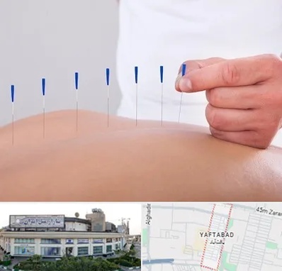 دکتر طب سوزنی در یافت آباد